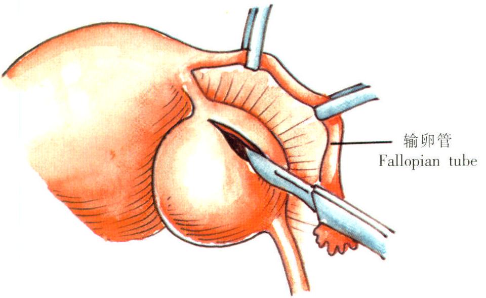 卵巢巧克力囊肿手术图片
